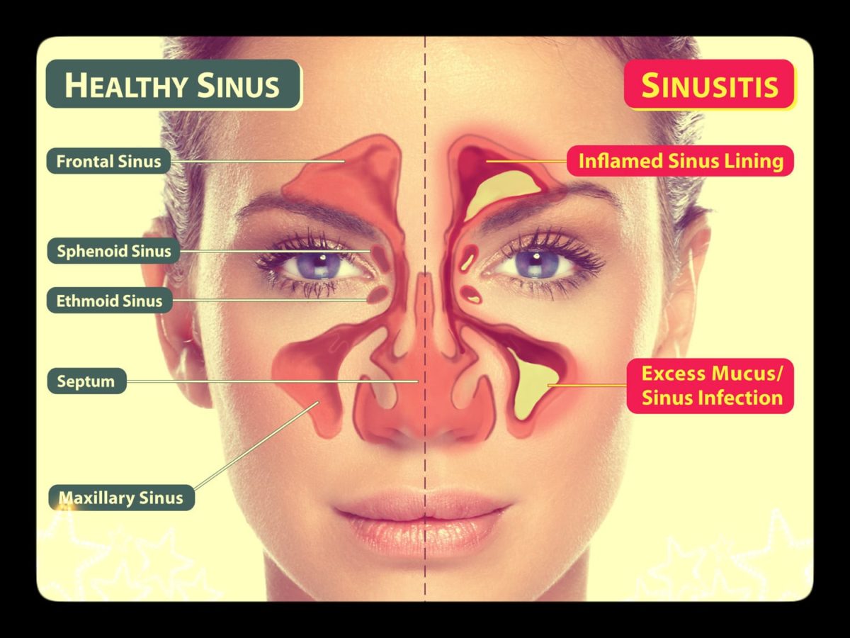Understanding Sinus - Health Holistic