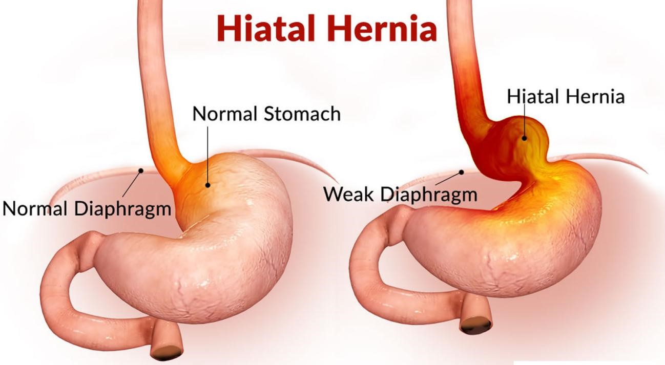 https://www.healthholistic.com/wp-content/uploads/2023/09/HIATUS-HERNIA.jpg
